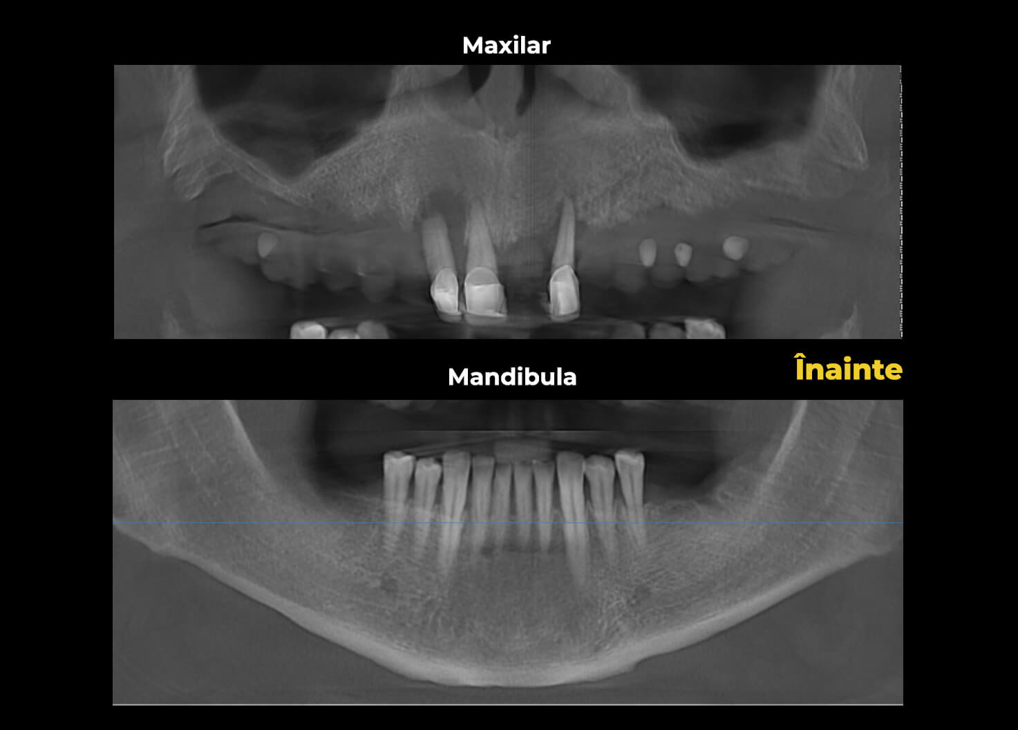 Evaluare radiologică inițială a pacientului Ionel Băcăuanu, prezentând situația clinică de start.